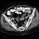Dermoid of ovary: CT - Computed tomography